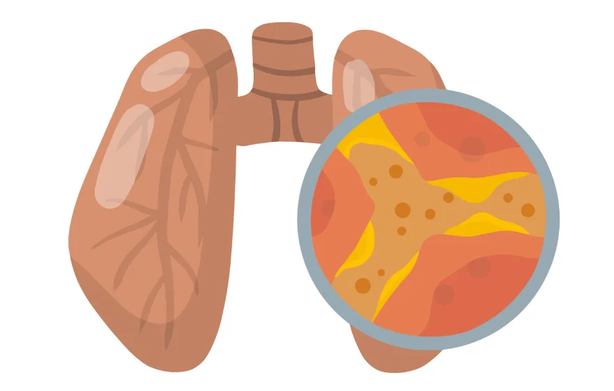 bronchiectasis-banner (2).webp