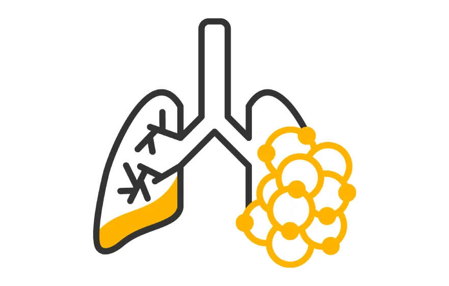 bronchiectasis-banner (3).webp