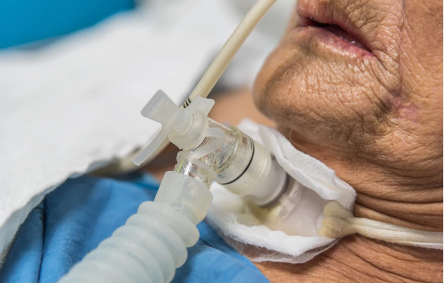 overview-racheostomy.webp
