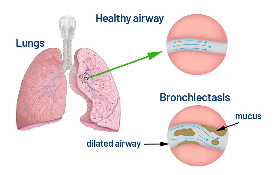 bronchiectasis-banner.webp