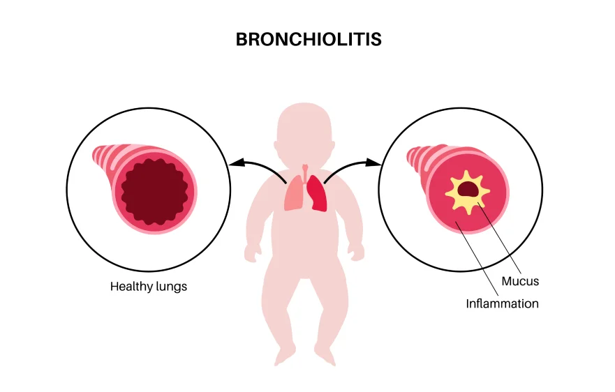 bronchiolitis-banner (1).webp