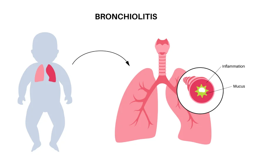 bronchiolitis-banner (2).webp