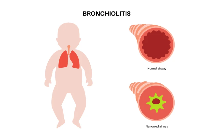 bronchiolitis-banner (3).webp
