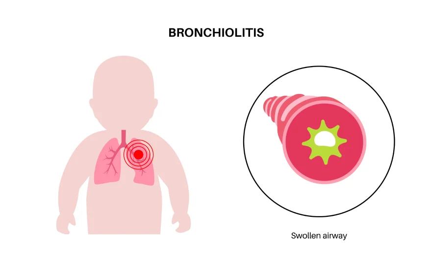 bronchiolitis-banner.webp