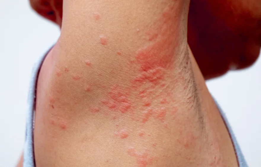 dermatitis-banner (1).webp