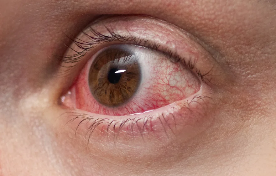 dry-eyes-banner (2).webp