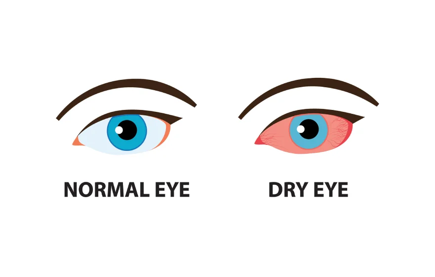 dry-eyes-banner.webp