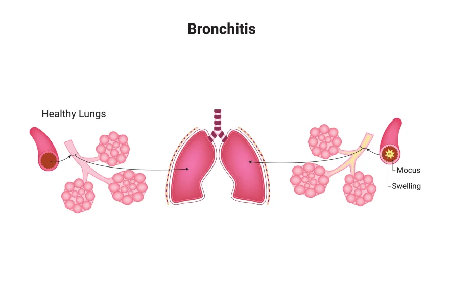 bronchitis-banner (1).webp