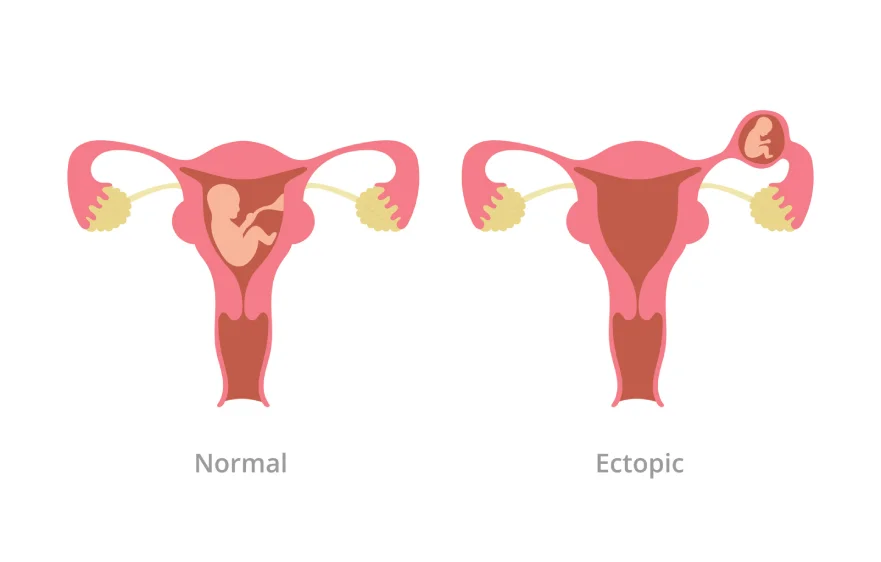 ectopic-pregnancy-banner (1).webp