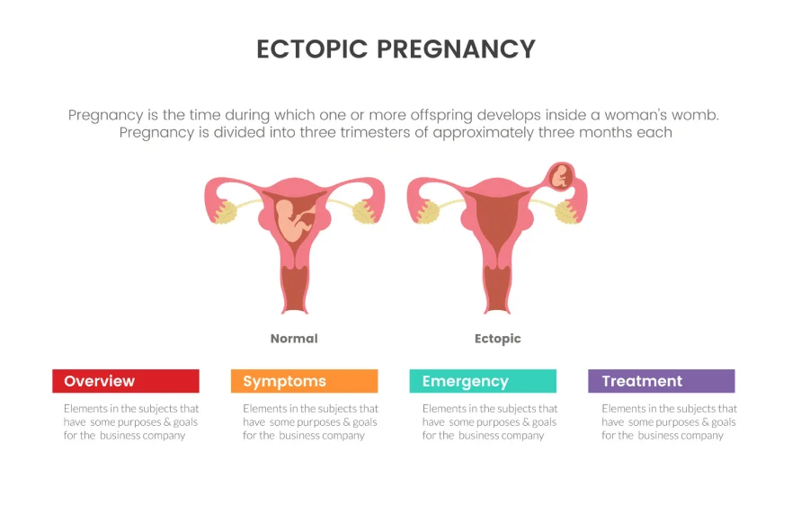 ectopic-pregnancy-banner.webp