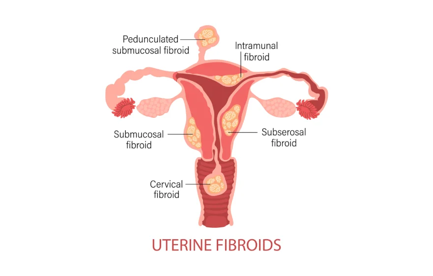 fibroid-uterus-banner4.webp