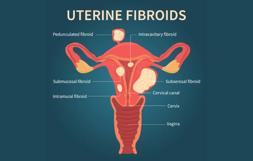 fibroid-uterus-banner5.webp