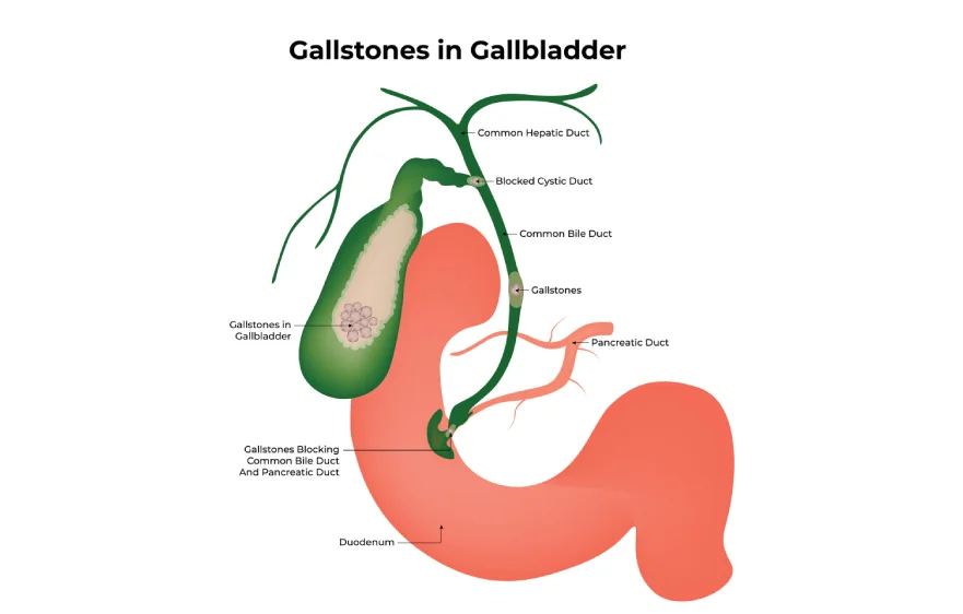 gallstones-banner (1).webp