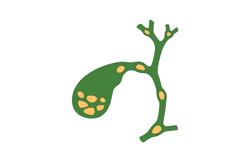 gallstones-banner (2).webp