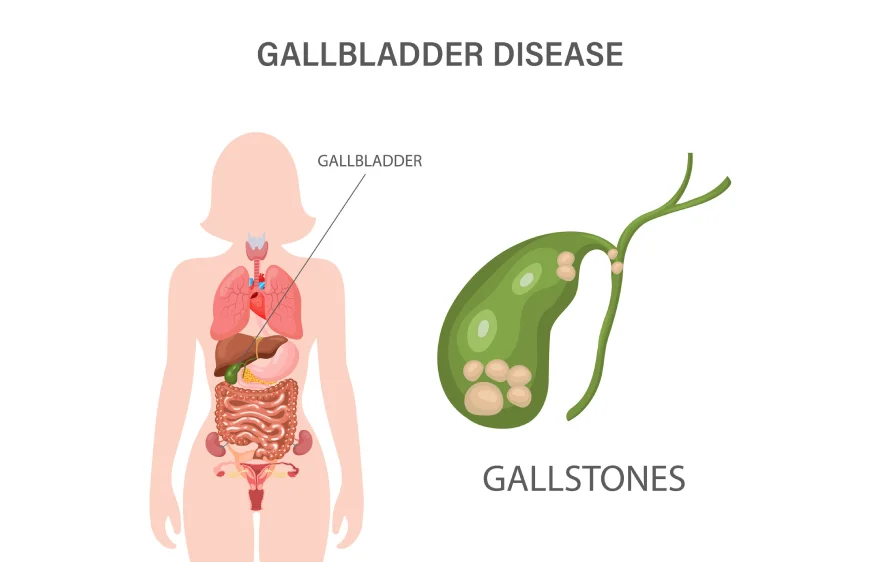 gallstones-banner.webp