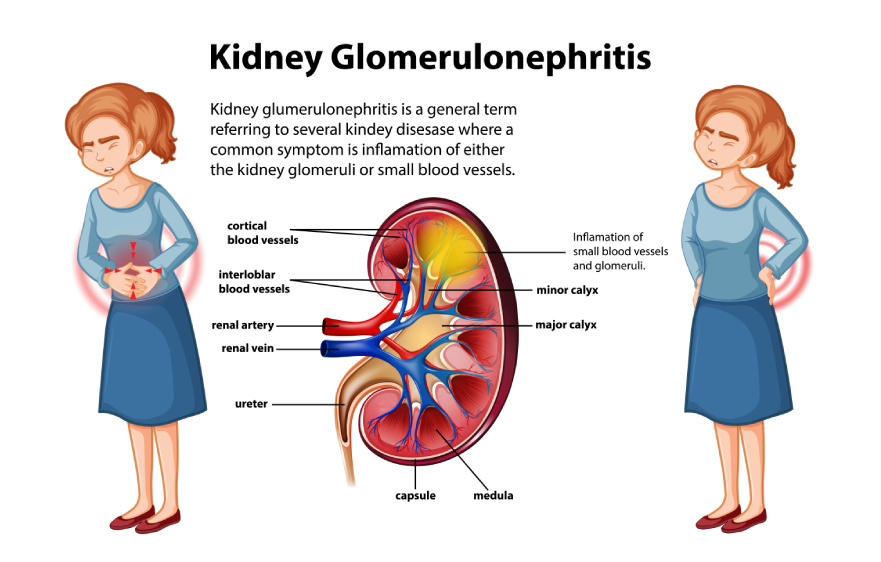 glomerulonephritis-banner.webp