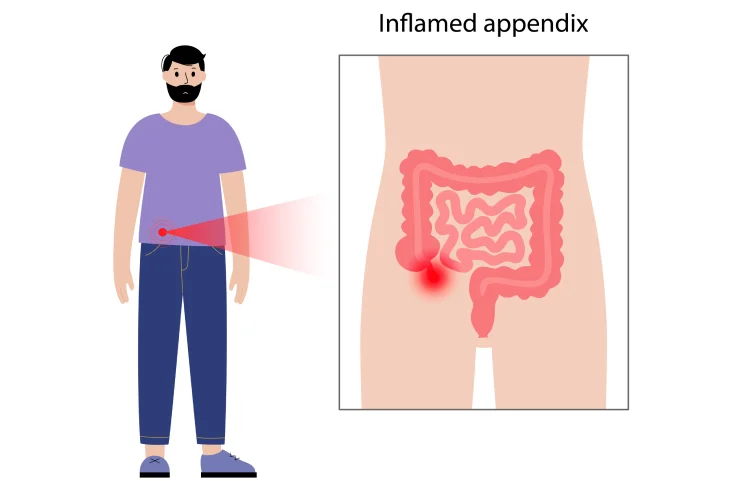 acute-appendicitis-banner7.webp