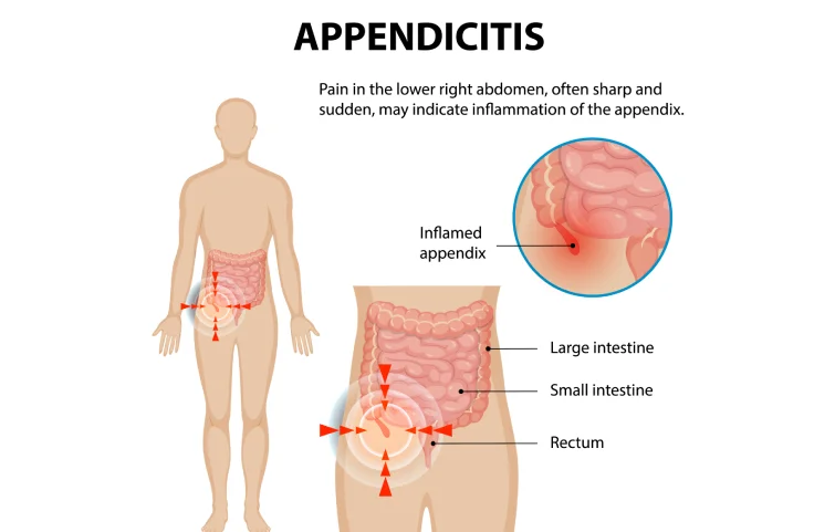 acute-appendicitis-banner9 (1).webp