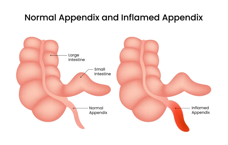 acute-appendicitis-banner9.webp