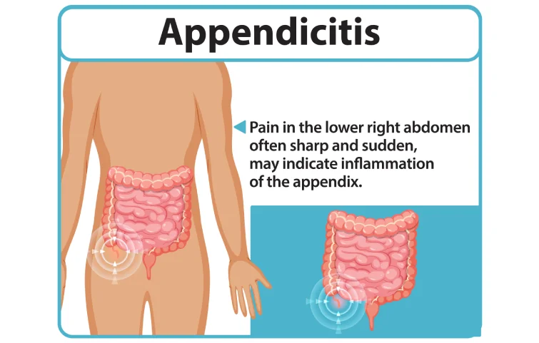 acute-appendicitis-banner11.webp