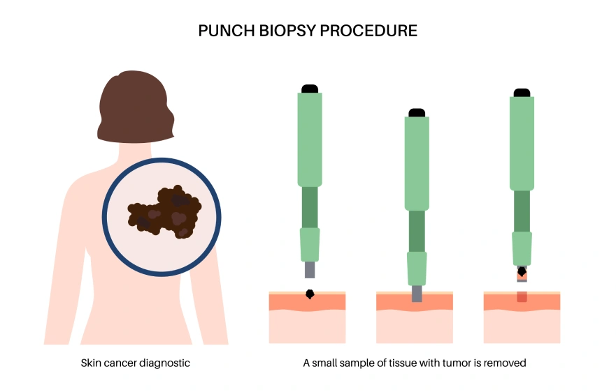 Skin Biopsy.webp