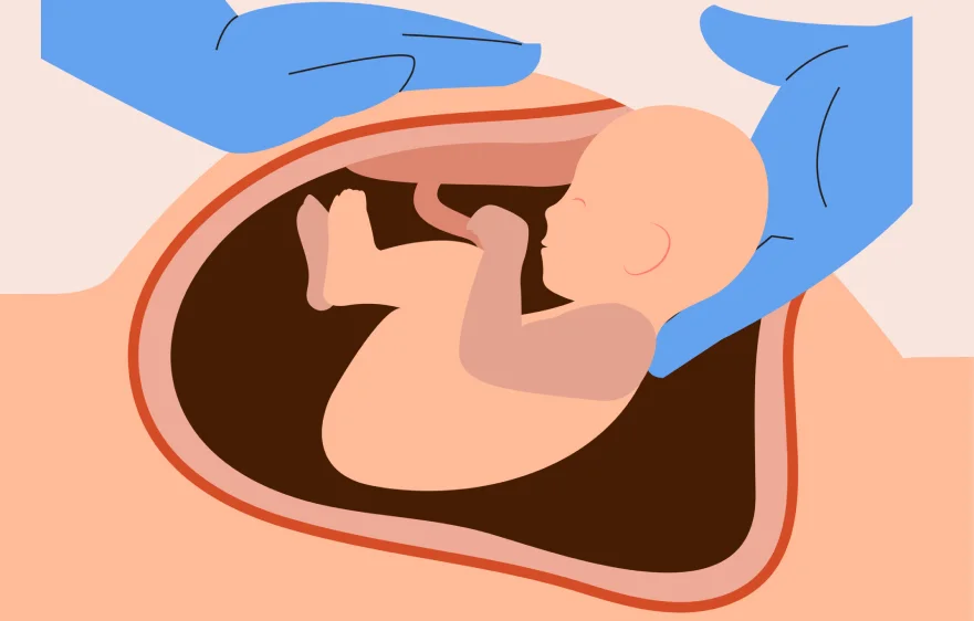cesarean-banner.webp