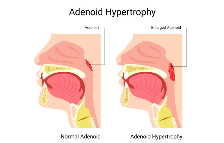 adenoid-disease-banner2.webp