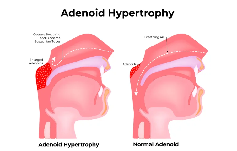 adenoid-disease-banner3.webp