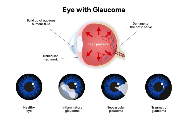 71asi_glaucoma1.webp