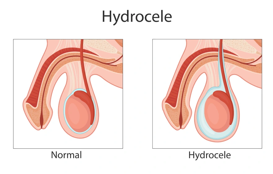 73procs_overview-hydrocele-repair.webp