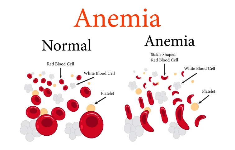 anemia-banner.webp
