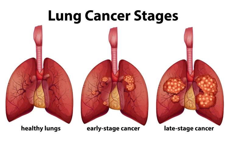 7asi_lungcancer1.webp