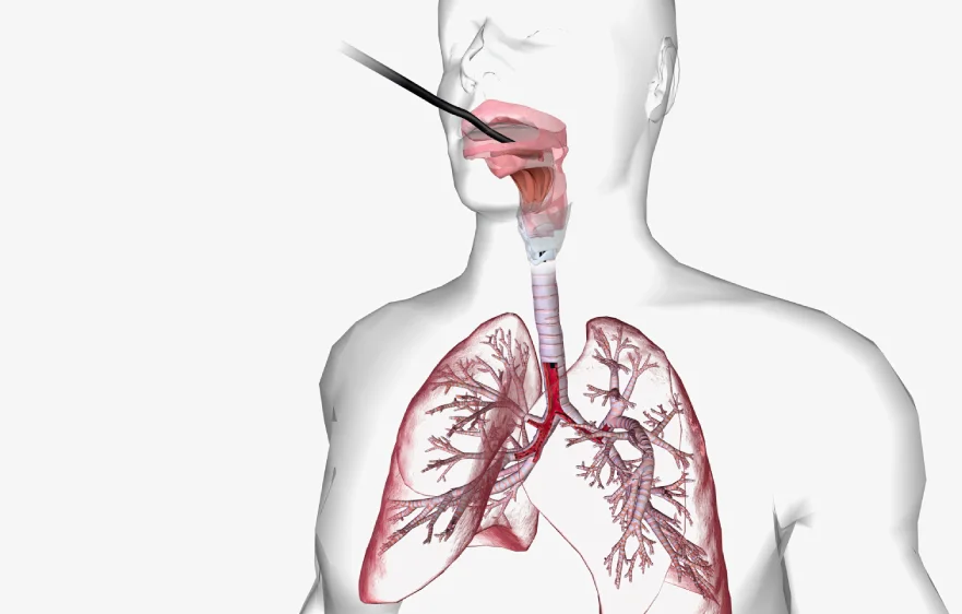 bronchoscopy-overview3.webp
