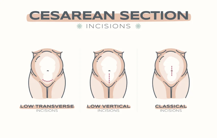 80procs_cesarean-delivery.webp