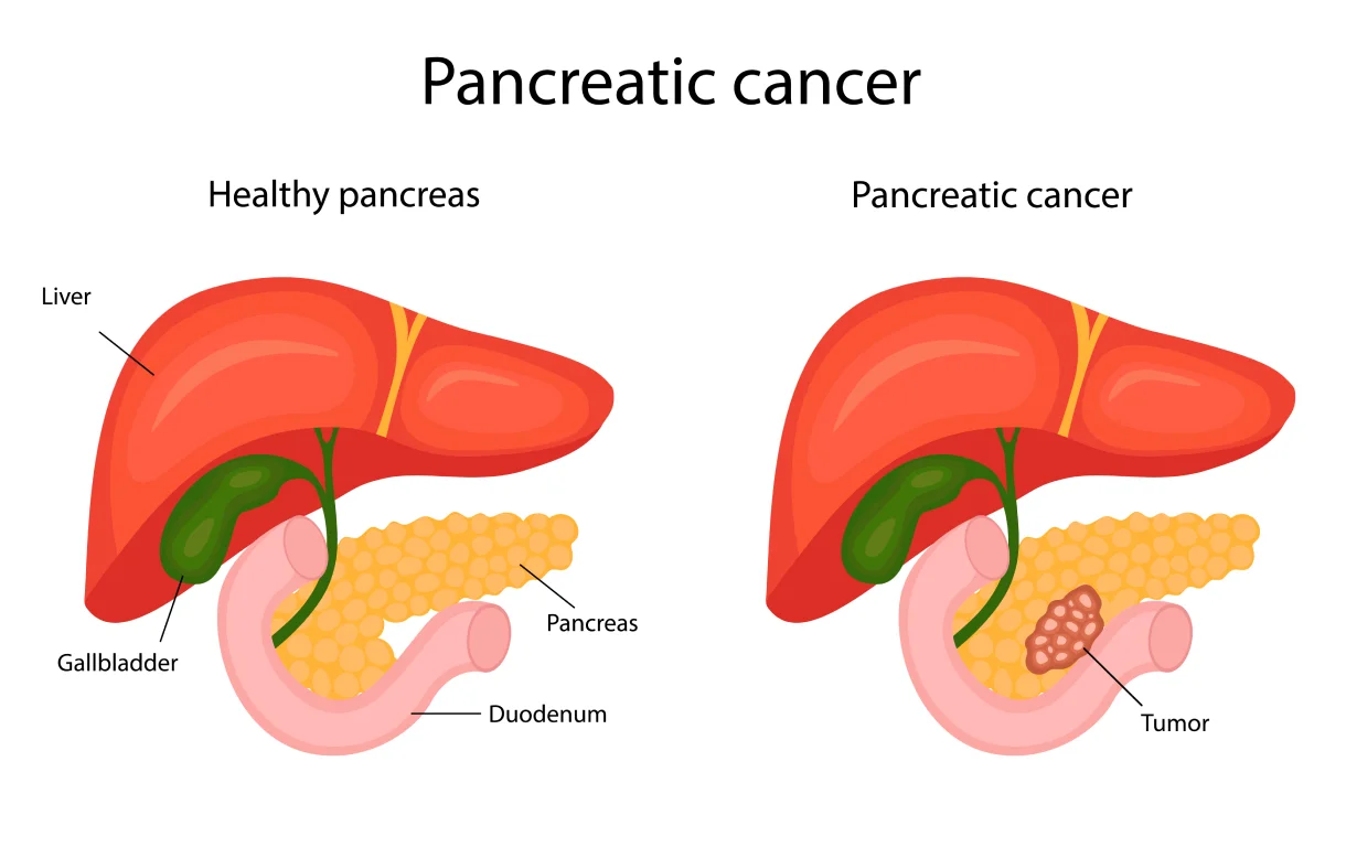 82asi_pancreatic1.webp