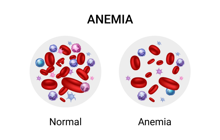 anemia-bannernew.webp