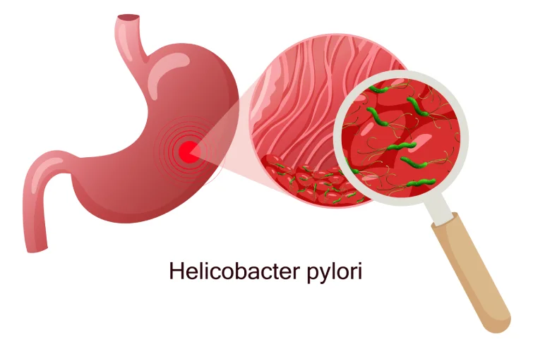 peptic-ulcer-banner2.webp