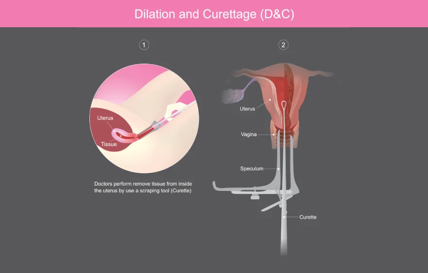 91procs_dilation-curettage-overview.webp