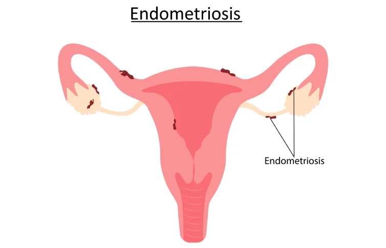 93asi_endometriosis1.webp