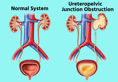 Ureteropelvic-Junction-UPJ-Obstruction